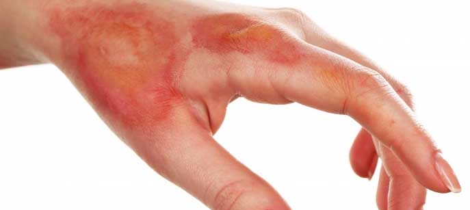 Proper First Aid For Burns And Scalds